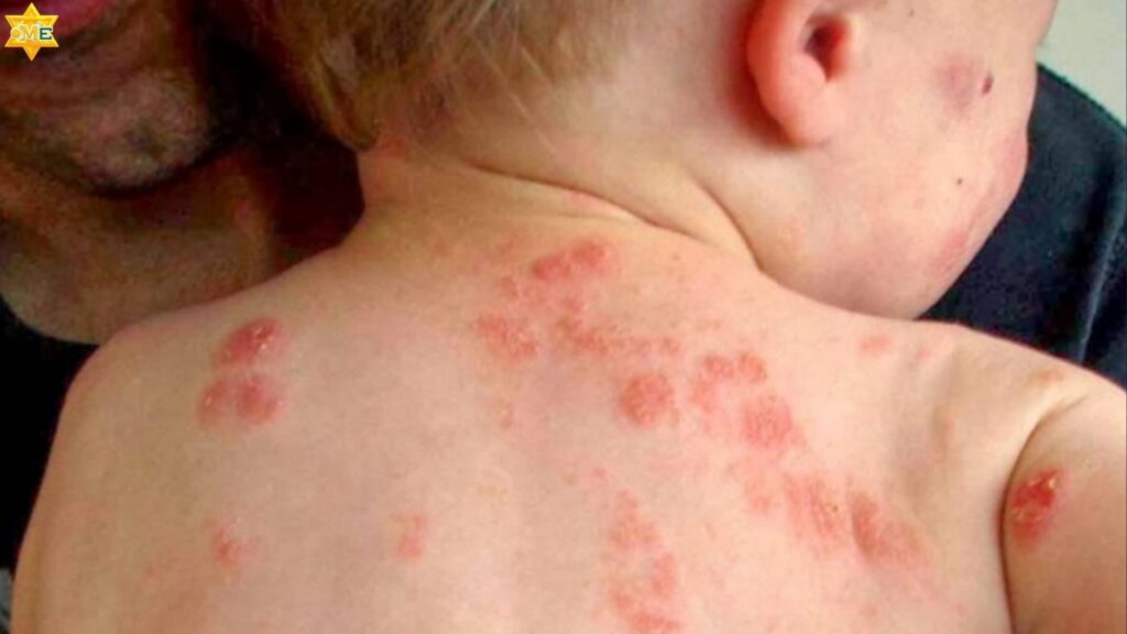 Nấm Candida là nguyên nhân chính gây ra hăm tã ở bé