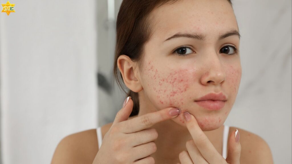 Các cách chăm sóc da mụn hiệu quả tại nhà