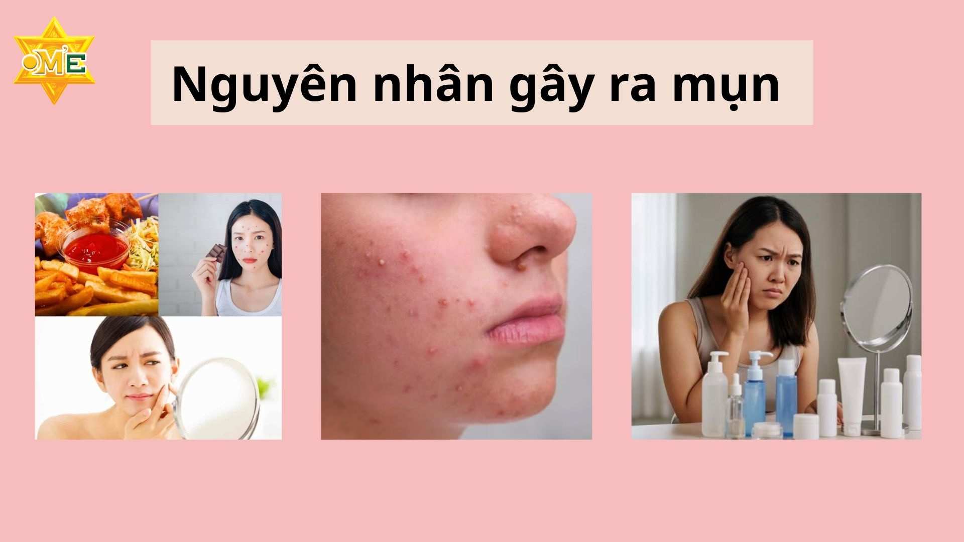 Các bước chăm sóc da mụn cơ bản