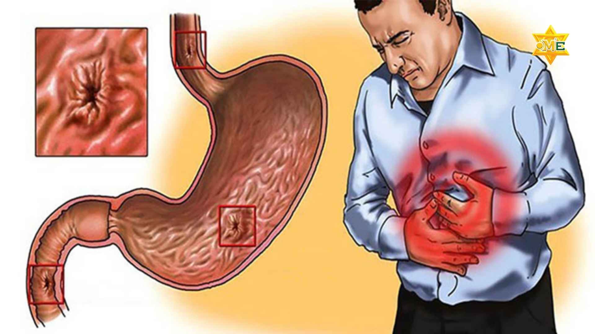 Triệu chứng của đau dạ dày