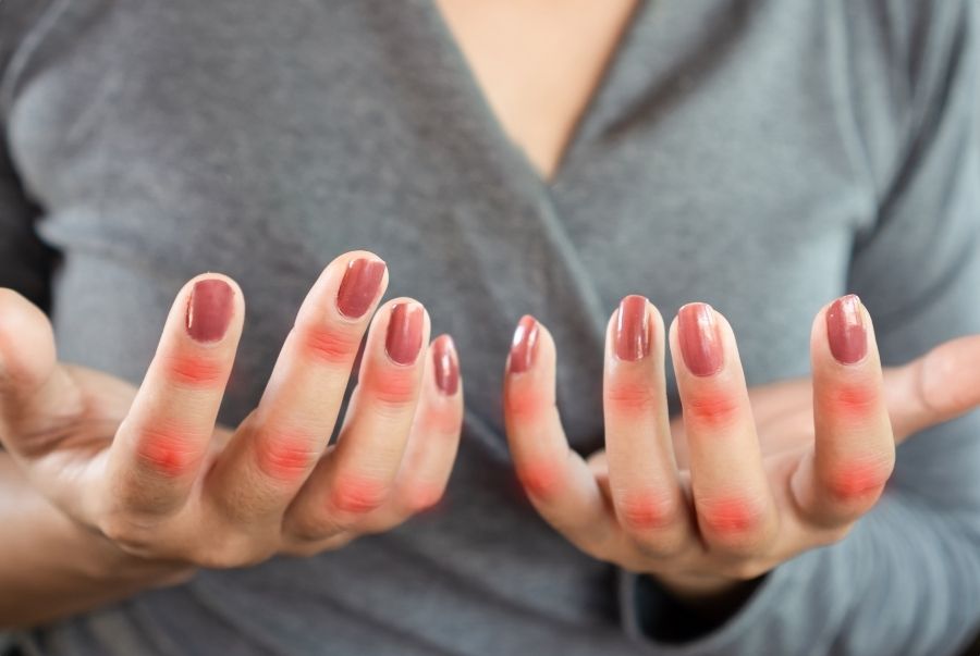 hiện tượng bệnh gout