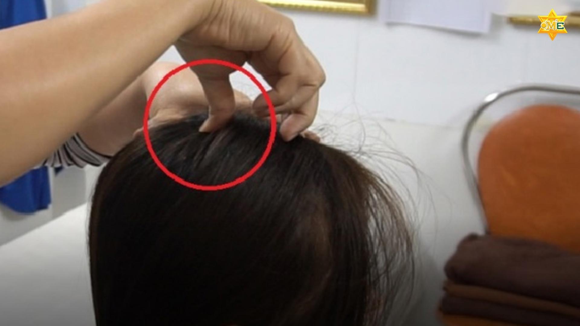 Hướng dẫn cách xác định huyệt trên đầu