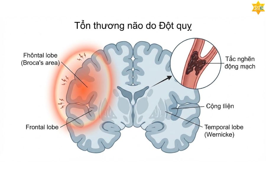 Tại sao bị rối loạn ngôn ngữ?