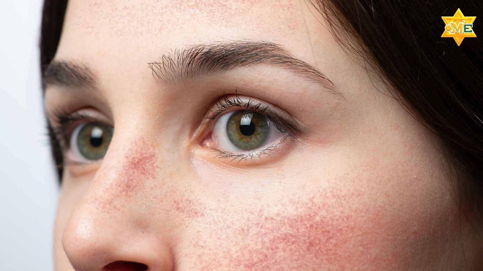 Lupus ban đỏ: Dinh dưỡng và chế độ ăn khoa học giúp cải thiện sức khỏe