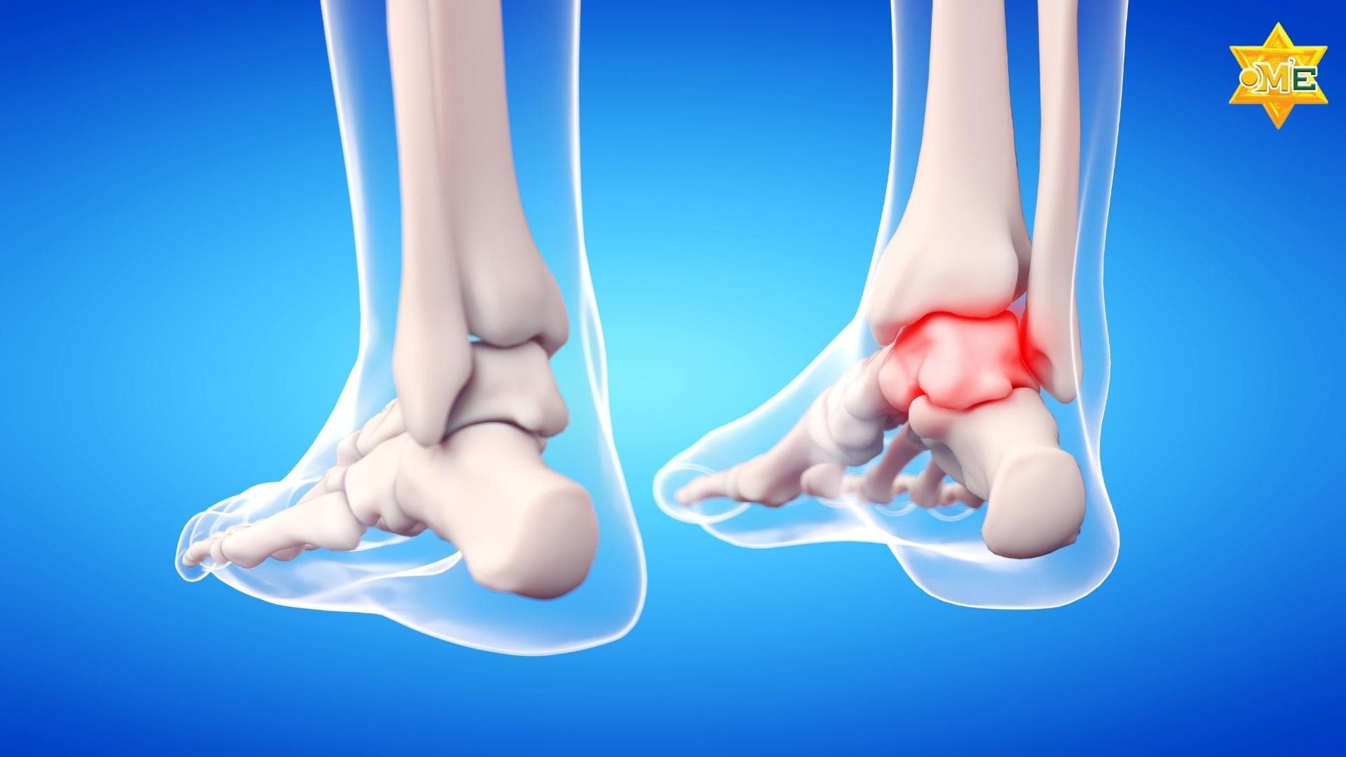 Tăng axit uric nên ăn gì? Hướng dẫn dinh dưỡng khoa học cho người bệnh Gout