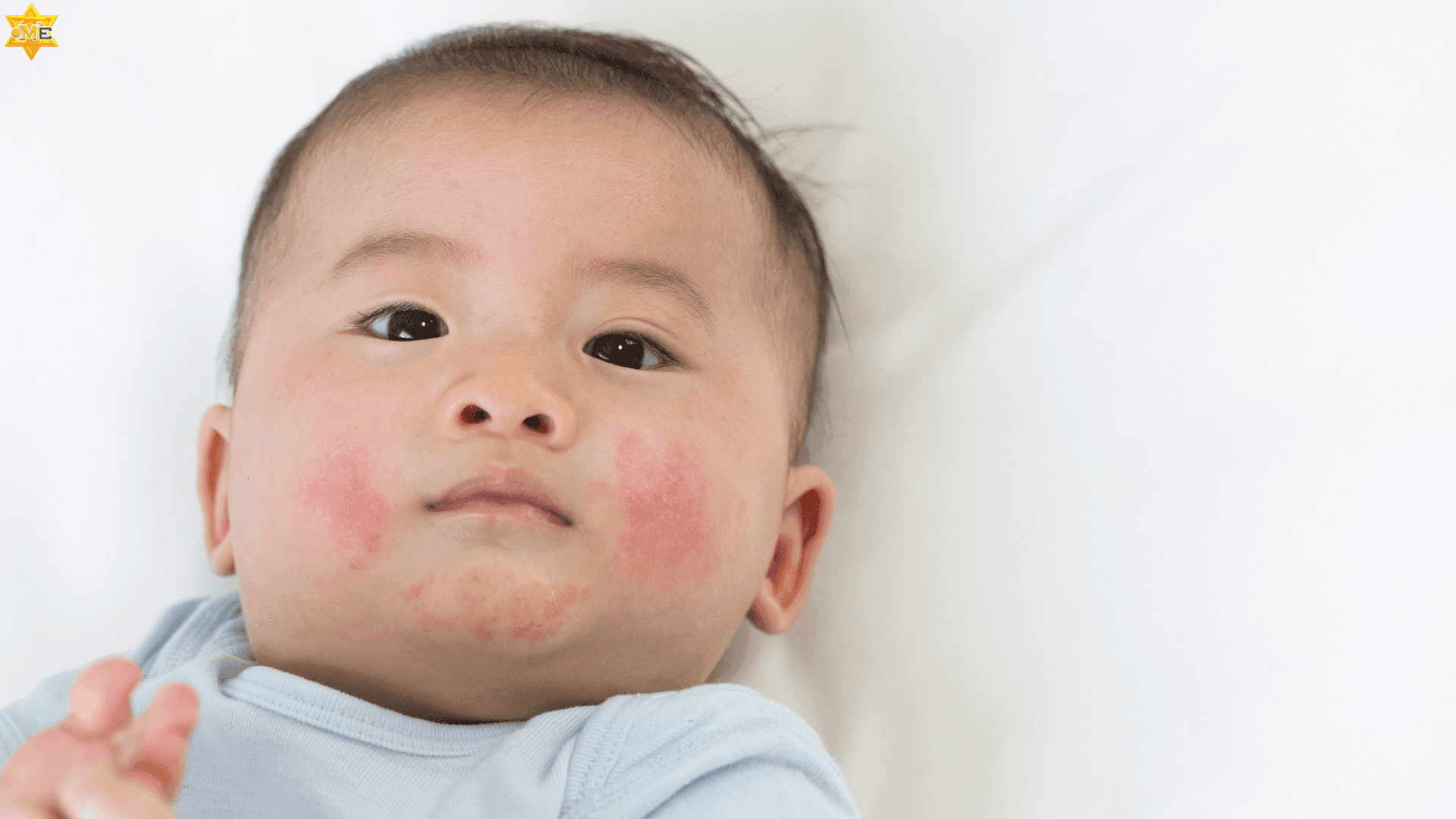 Mụn kê ở trẻ sơ sinh – Nhận biết và chăm sóc đúng cách