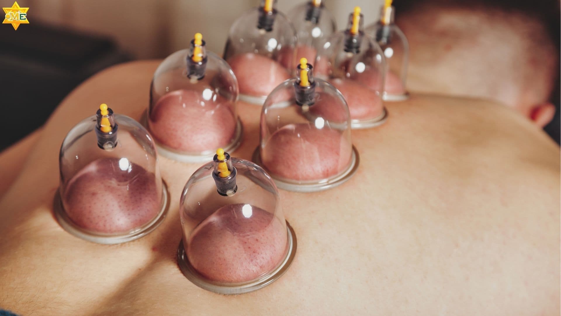 Giác hơi tại nhà: Cách thực hiện, lợi ích và lưu ý an toàn